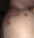 Nick Ostrowski, Shoulder surgery, February 2005