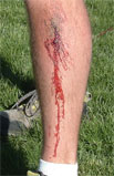Steve Ostrowski's bloody leg, 2006